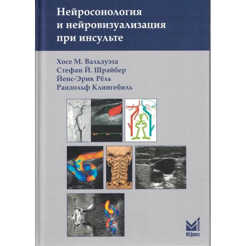 Нейросонология и нейровизуализация при инсульте